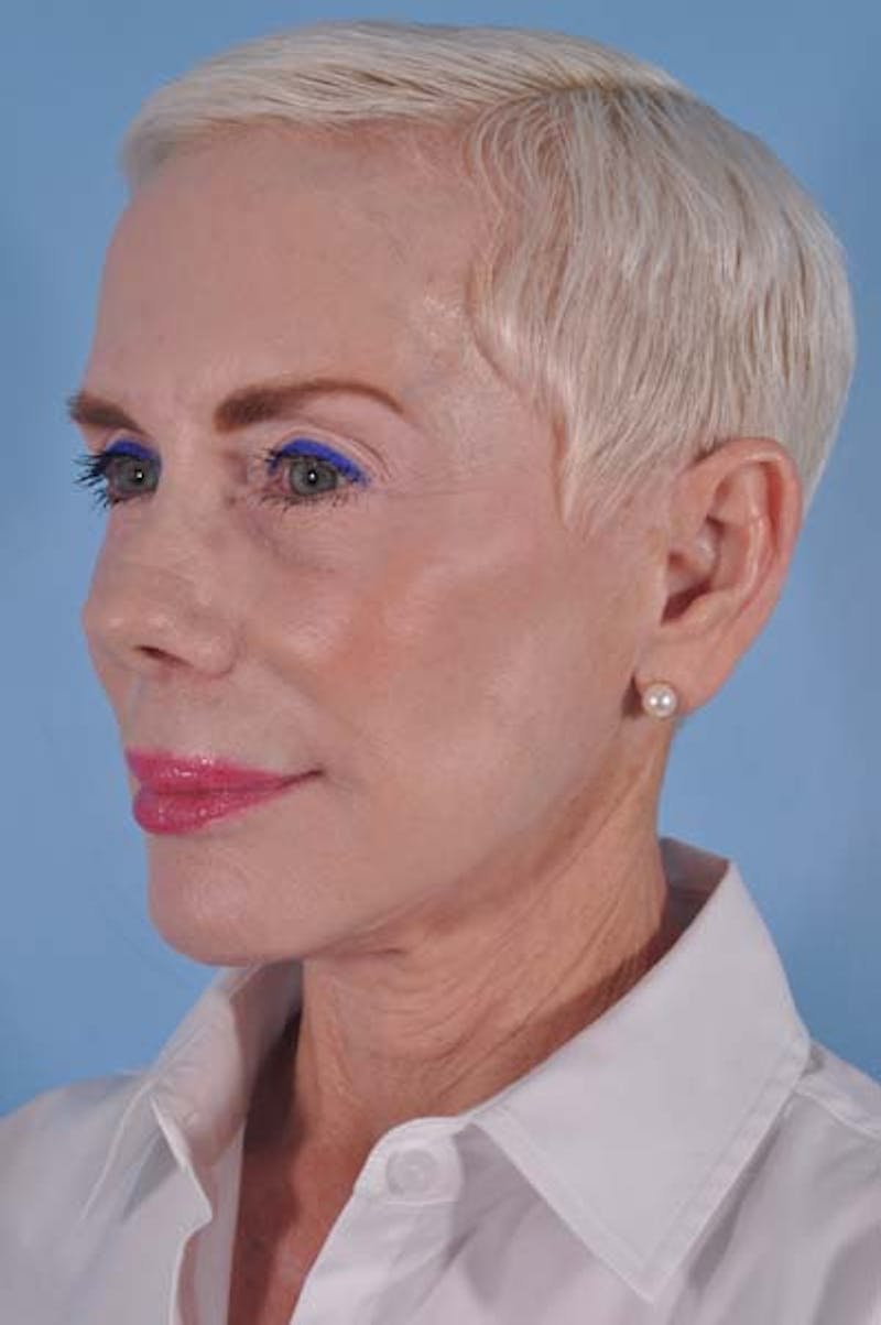 Facelift Surgery Before & After Gallery - Patient 245455 - Image 3