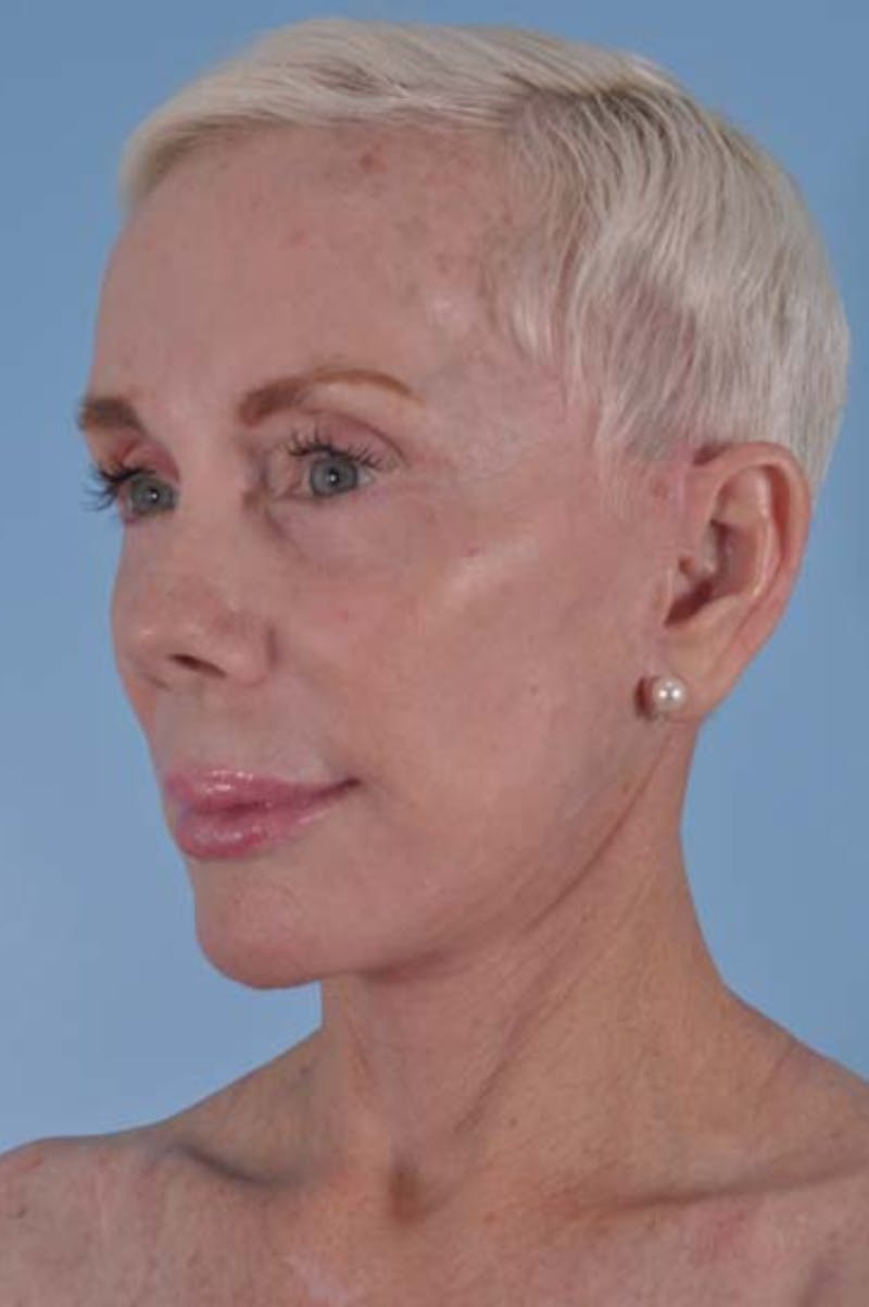 Facelift Surgery Before & After Gallery - Patient 245455 - Image 4