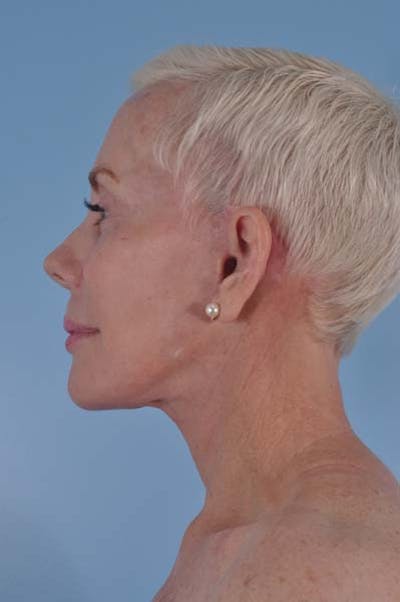Neck Lift Before & After Gallery - Patient 156789 - Image 2