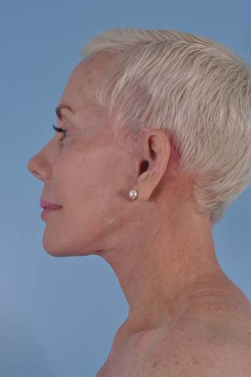 Facelift Surgery Before & After Gallery - Patient 245455 - Image 6