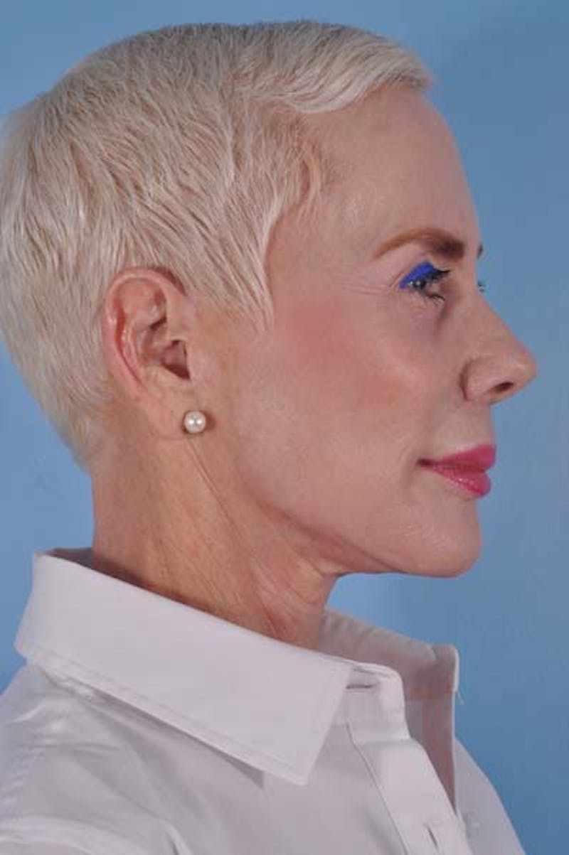 Facelift Surgery Before & After Gallery - Patient 245455 - Image 7