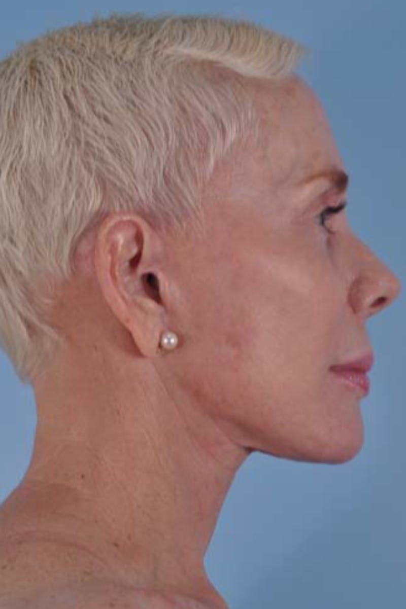Facelift Surgery Before & After Gallery - Patient 245455 - Image 8