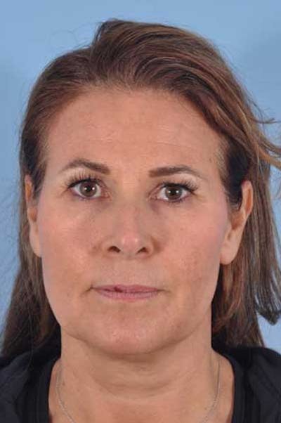 Facelift Surgery Before & After Gallery - Patient 307874 - Image 1