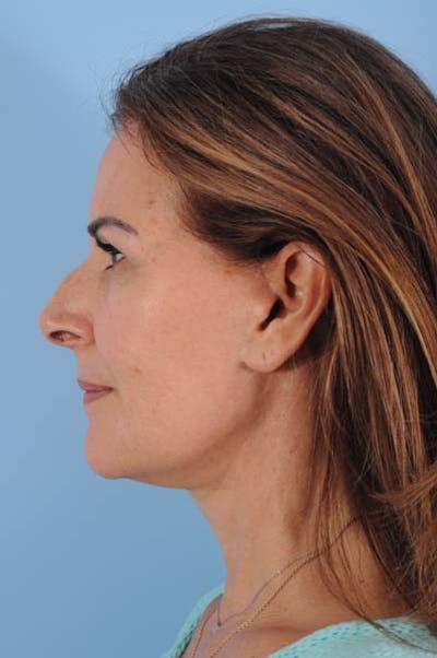 Neck Lift Before & After Gallery - Patient 183208 - Image 2