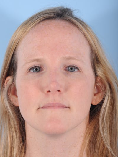 IPL Photofacial Before & After Gallery - Patient 208336 - Image 2