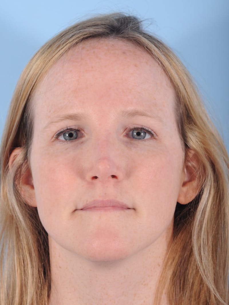 Rhinoplasty Before & After Gallery - Patient 415773 - Image 4