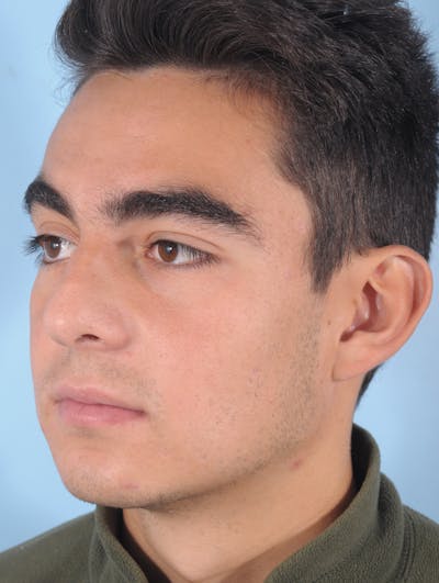 Rhinoplasty Before & After Gallery - Patient 389600 - Image 1