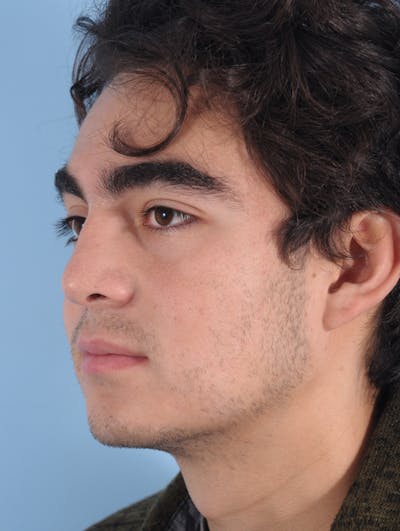 Rhinoplasty Before & After Gallery - Patient 389600 - Image 2