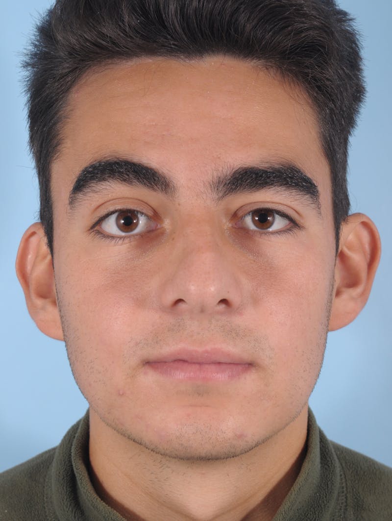 Rhinoplasty Before & After Gallery - Patient 389600 - Image 3