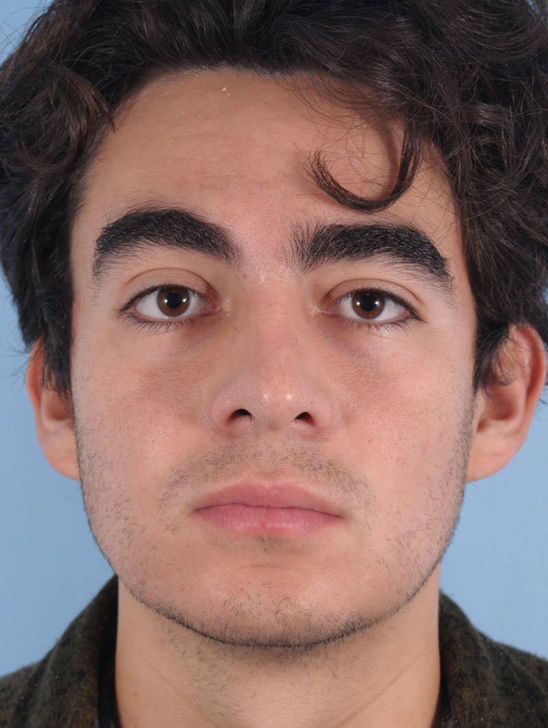 Rhinoplasty Before & After Gallery - Patient 389600 - Image 4