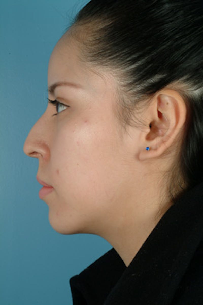 Rhinoplasty Before & After Gallery - Patient 222830 - Image 1