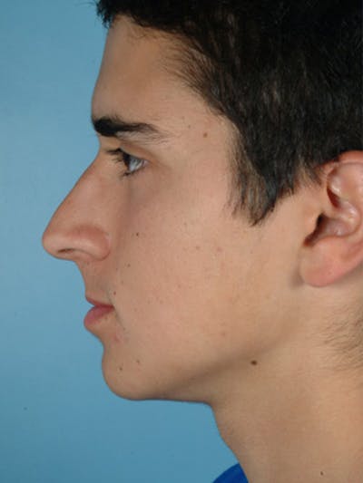 Rhinoplasty Before & After Gallery - Patient 255459 - Image 1