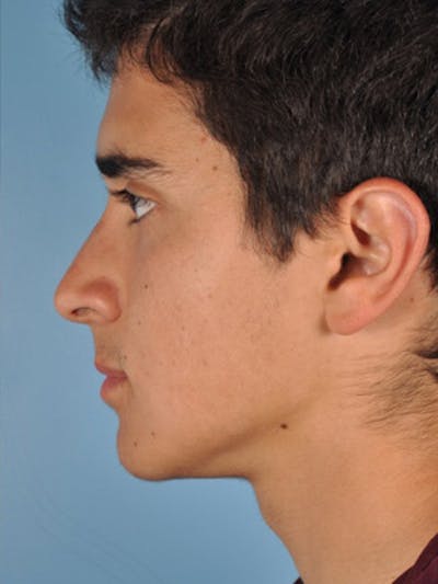 Rhinoplasty Before & After Gallery - Patient 255459 - Image 2