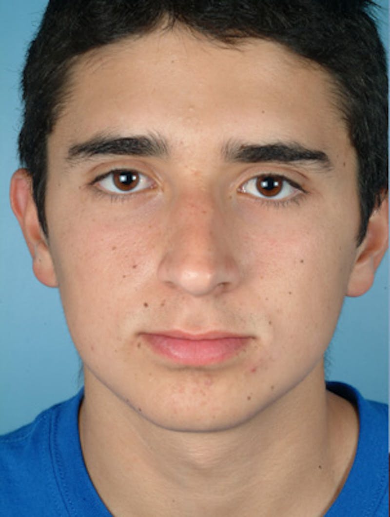 Rhinoplasty Before & After Gallery - Patient 255459 - Image 3