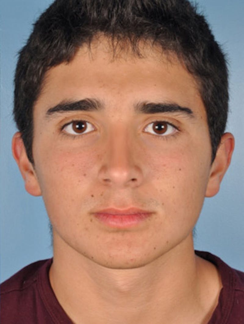 Rhinoplasty Before & After Gallery - Patient 255459 - Image 4