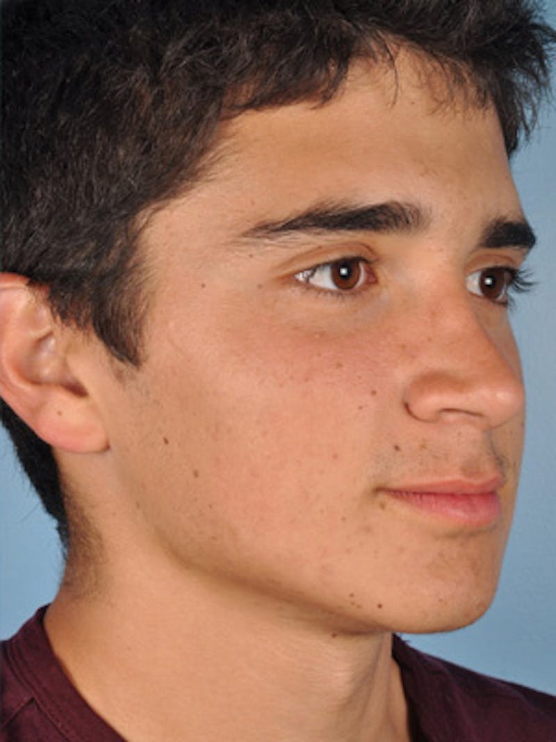 Rhinoplasty Before & After Gallery - Patient 255459 - Image 6