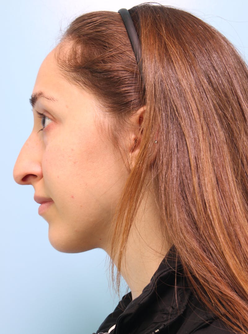 Rhinoplasty Before & After Gallery - Patient 103980 - Image 1