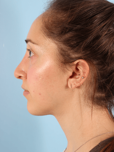 Rhinoplasty Before & After Gallery - Patient 103980 - Image 2