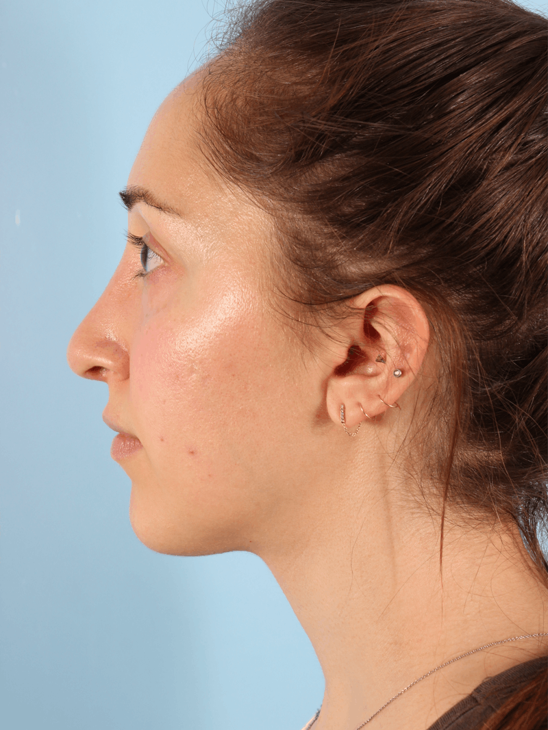 Rhinoplasty Before & After Gallery - Patient 103980 - Image 2