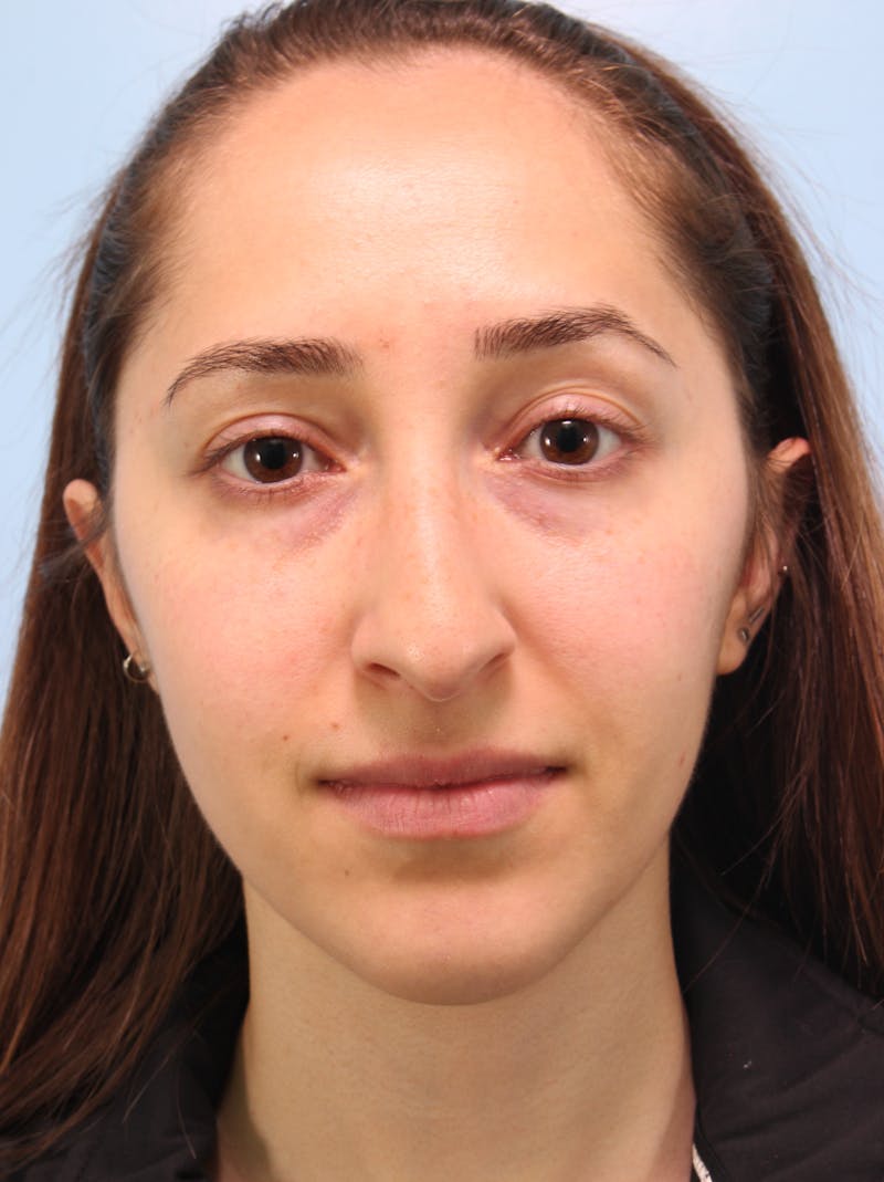 Rhinoplasty Before & After Gallery - Patient 103980 - Image 3