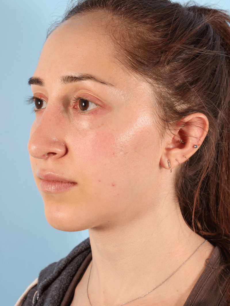 Rhinoplasty Before & After Gallery - Patient 103980 - Image 6