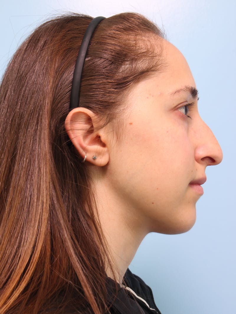Rhinoplasty Before & After Gallery - Patient 103980 - Image 7