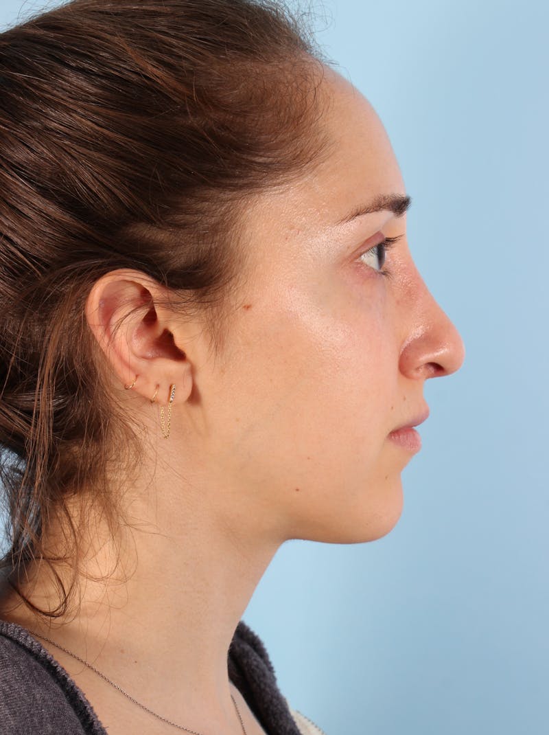 Rhinoplasty Before & After Gallery - Patient 103980 - Image 8