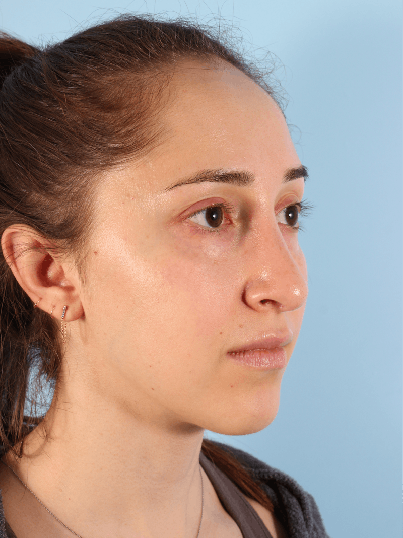 Rhinoplasty Before & After Gallery - Patient 103980 - Image 9