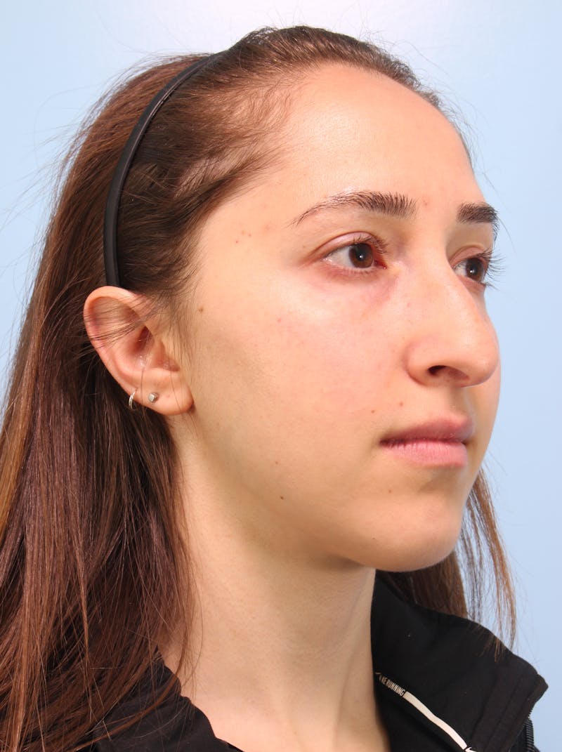 Rhinoplasty Before & After Gallery - Patient 103980 - Image 10