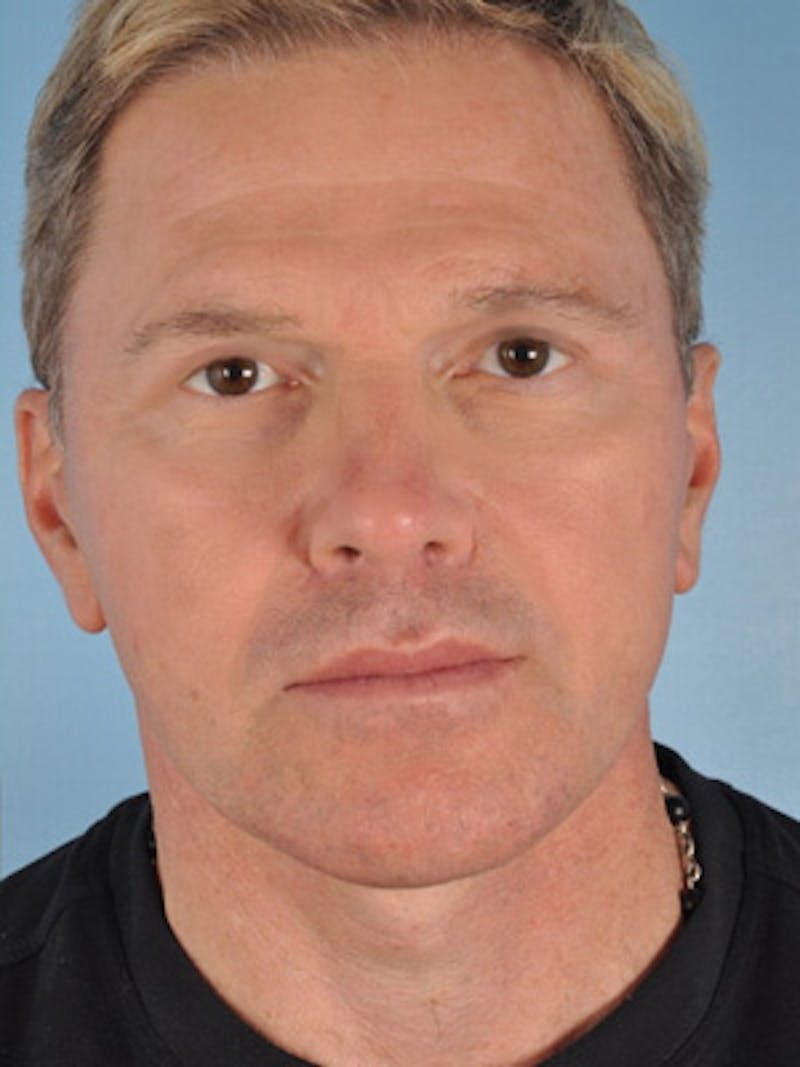 Rhinoplasty Before & After Gallery - Patient 143712 - Image 4