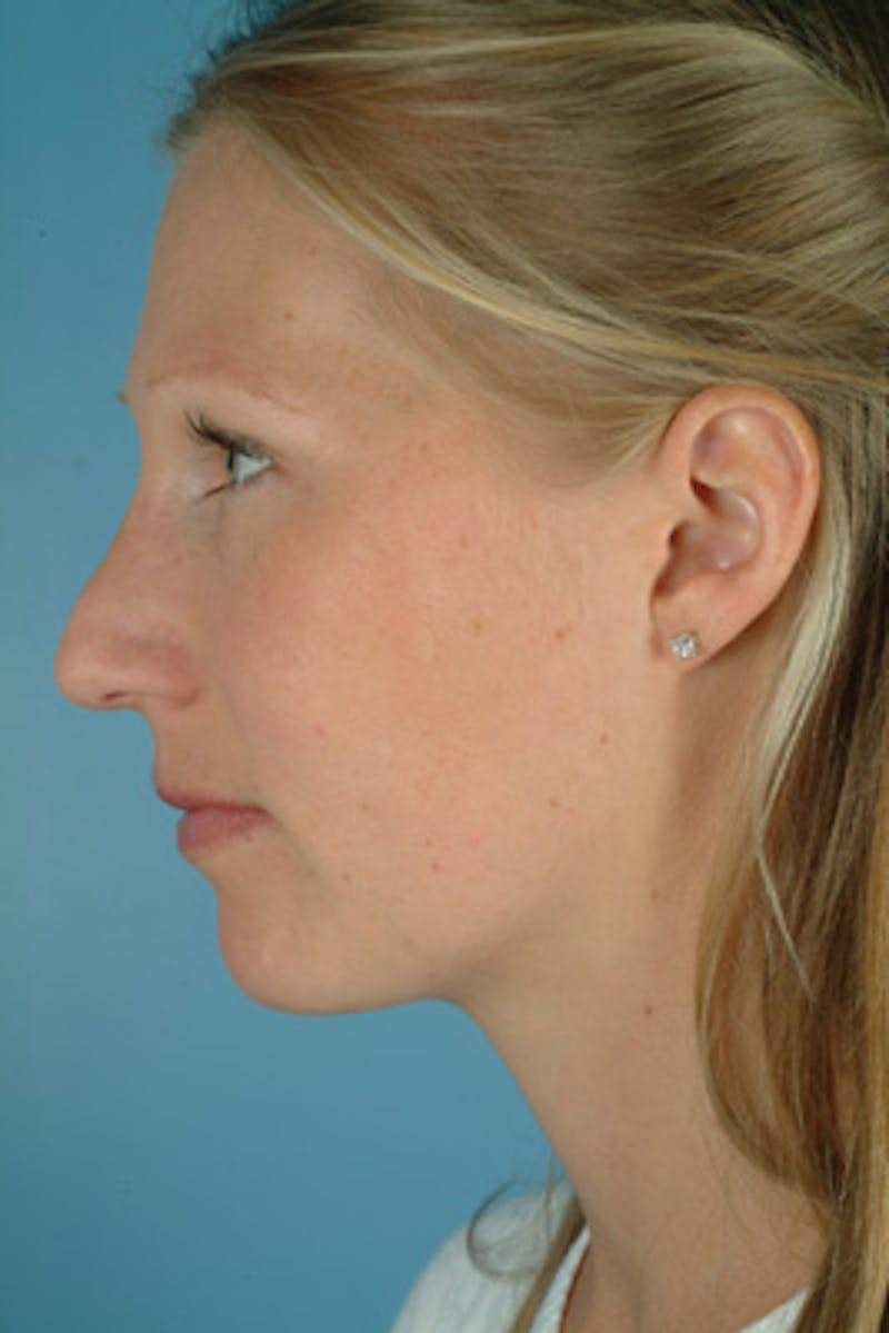 Rhinoplasty Before & After Gallery - Patient 673223 - Image 1