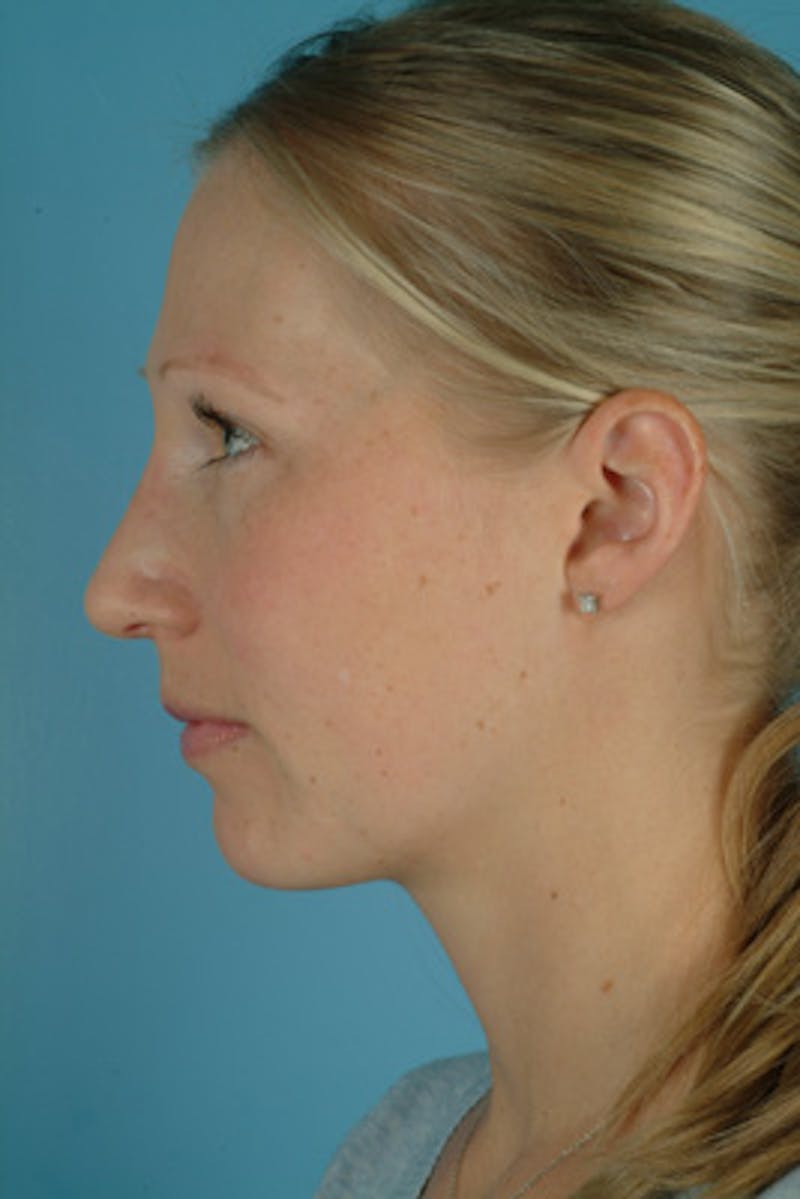 Rhinoplasty Before & After Gallery - Patient 673223 - Image 2