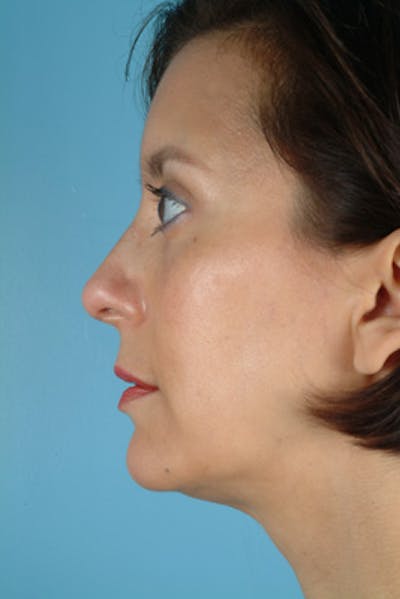 Rhinoplasty Before & After Gallery - Patient 402989 - Image 2