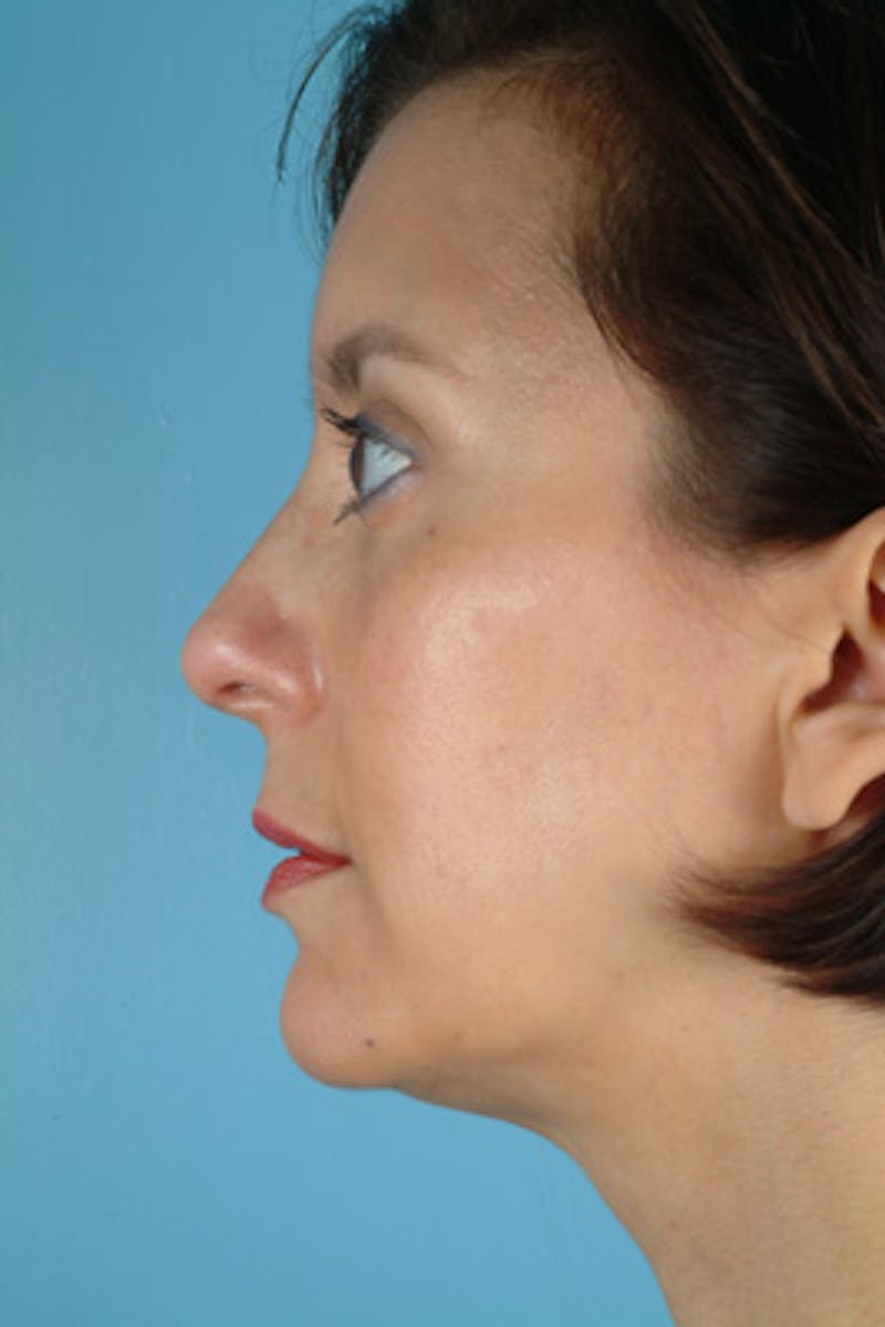 Rhinoplasty Before & After Gallery - Patient 402989 - Image 2