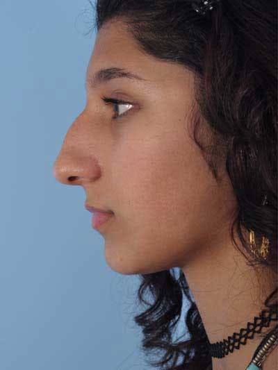 Rhinoplasty Before & After Gallery - Patient 201433 - Image 1