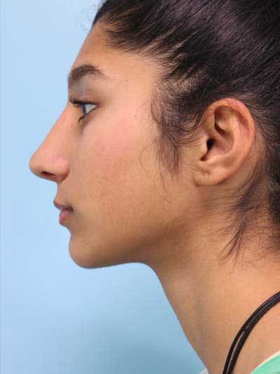 Rhinoplasty Before & After Gallery - Patient 201433 - Image 2