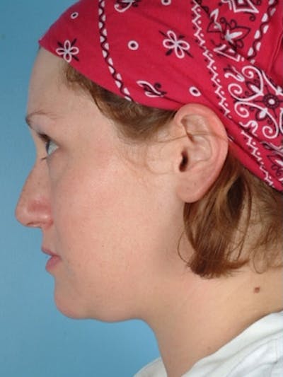 Rhinoplasty Before & After Gallery - Patient 221206 - Image 1