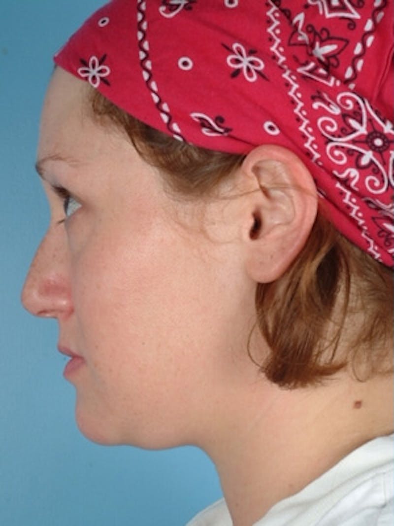 Rhinoplasty Before & After Gallery - Patient 221206 - Image 1