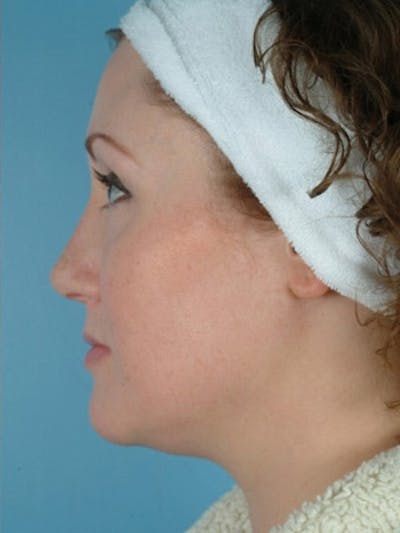 Rhinoplasty Before & After Gallery - Patient 221206 - Image 2