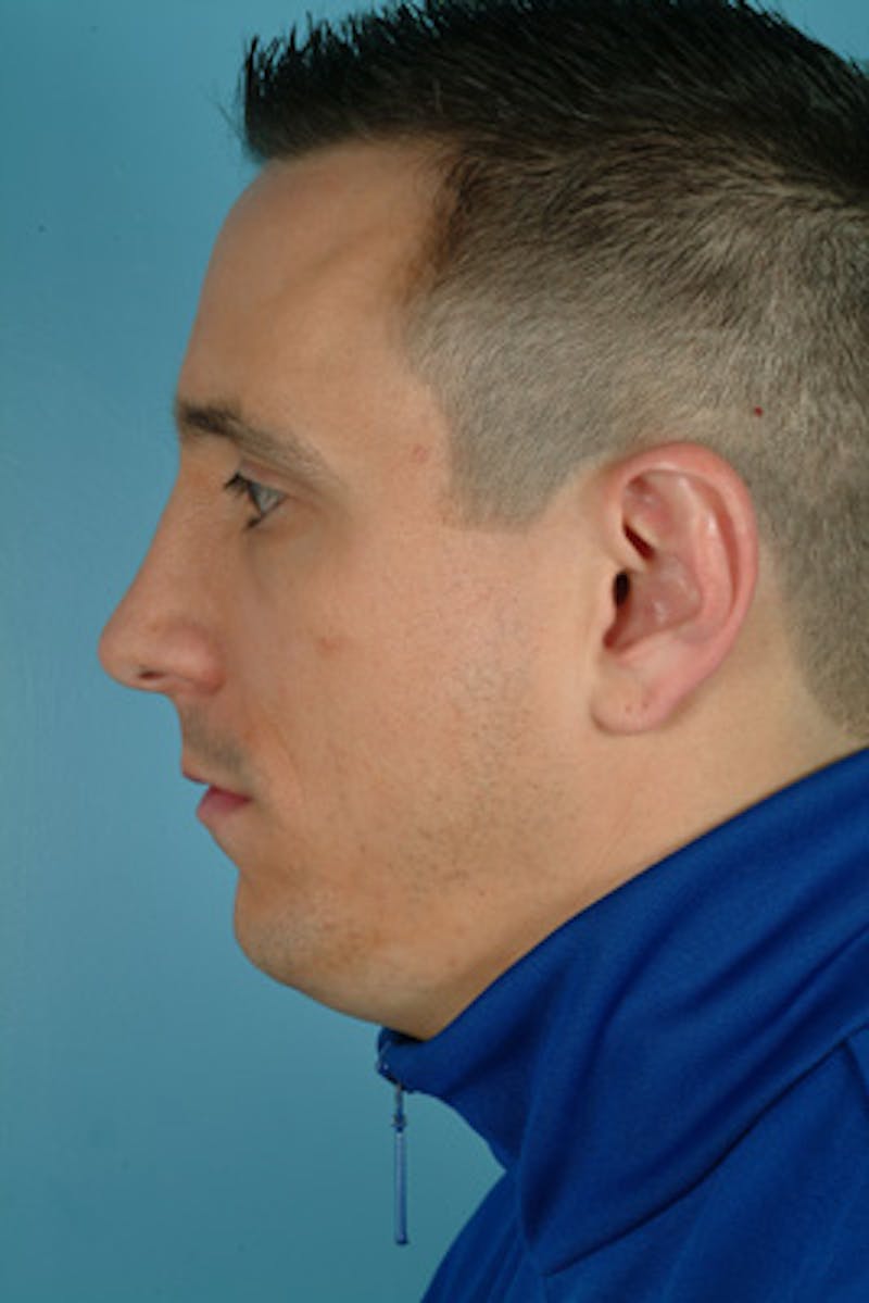 Rhinoplasty Before & After Gallery - Patient 242673 - Image 2