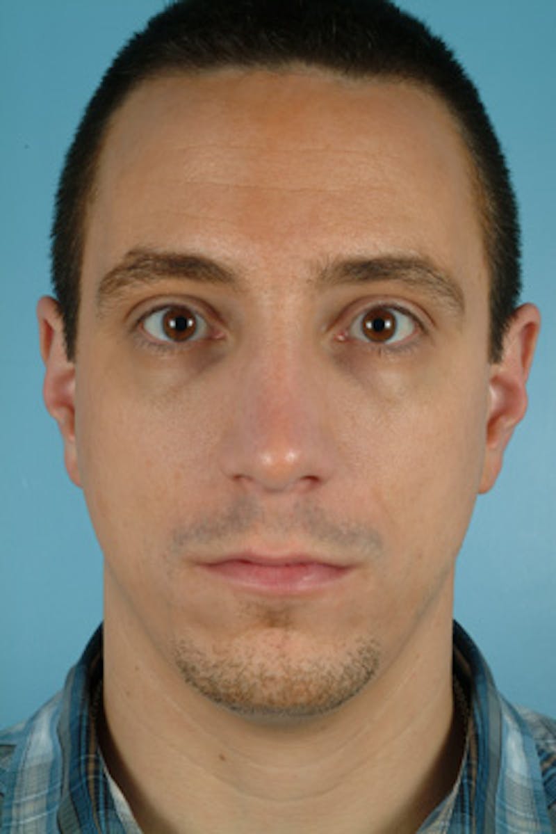 Rhinoplasty Before & After Gallery - Patient 242673 - Image 4