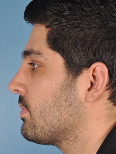Rhinoplasty Before & After Gallery - Patient 402860 - Image 2