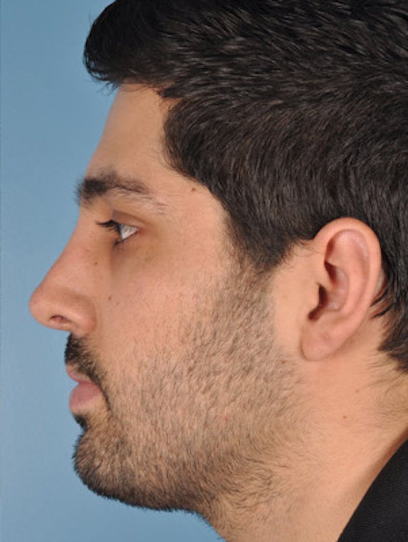 Rhinoplasty Before & After Gallery - Patient 402860 - Image 2