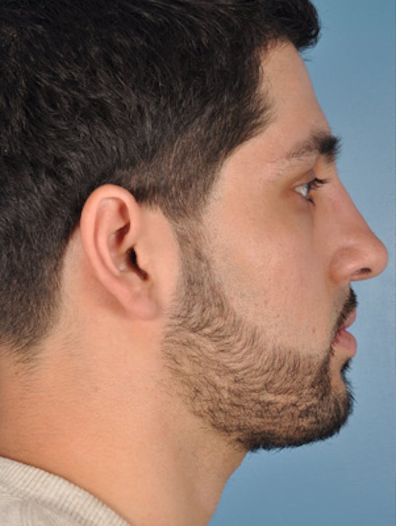 Rhinoplasty Before & After Gallery - Patient 402860 - Image 3