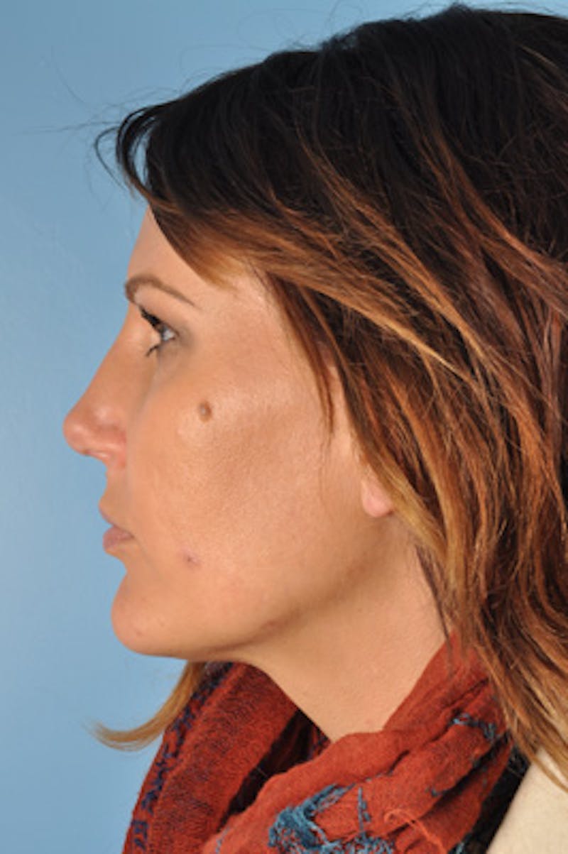 Rhinoplasty Before & After Gallery - Patient 119099 - Image 2