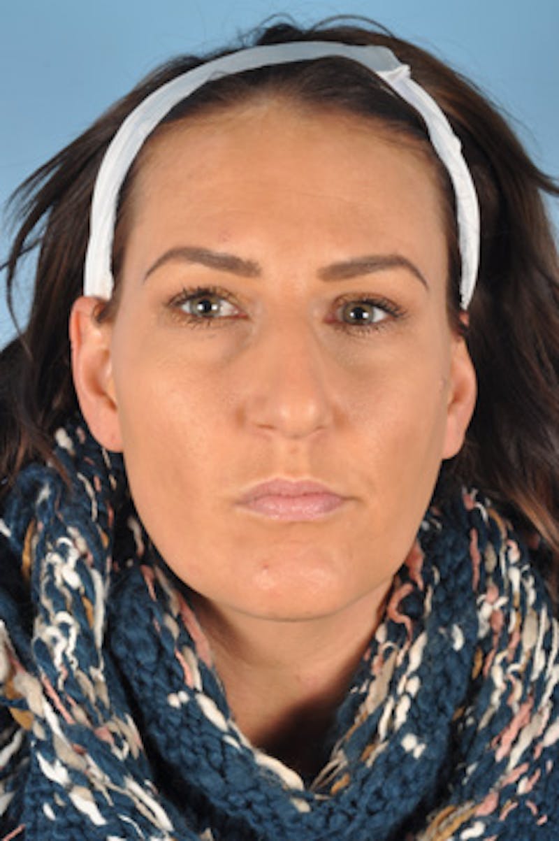 Rhinoplasty Before & After Gallery - Patient 119099 - Image 3