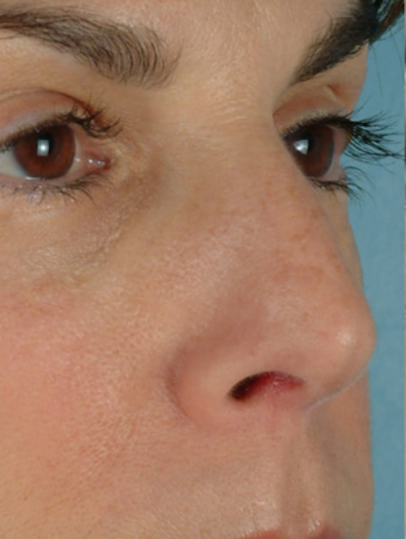 Rhinoplasty Before & After Gallery - Patient 280890 - Image 3