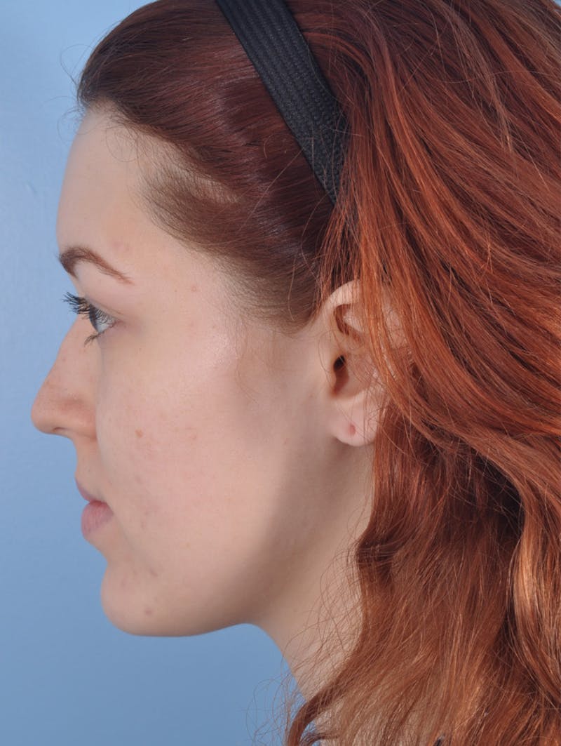 Rhinoplasty Before & After Gallery - Patient 295083 - Image 1