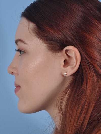 Rhinoplasty Before & After Gallery - Patient 295083 - Image 2