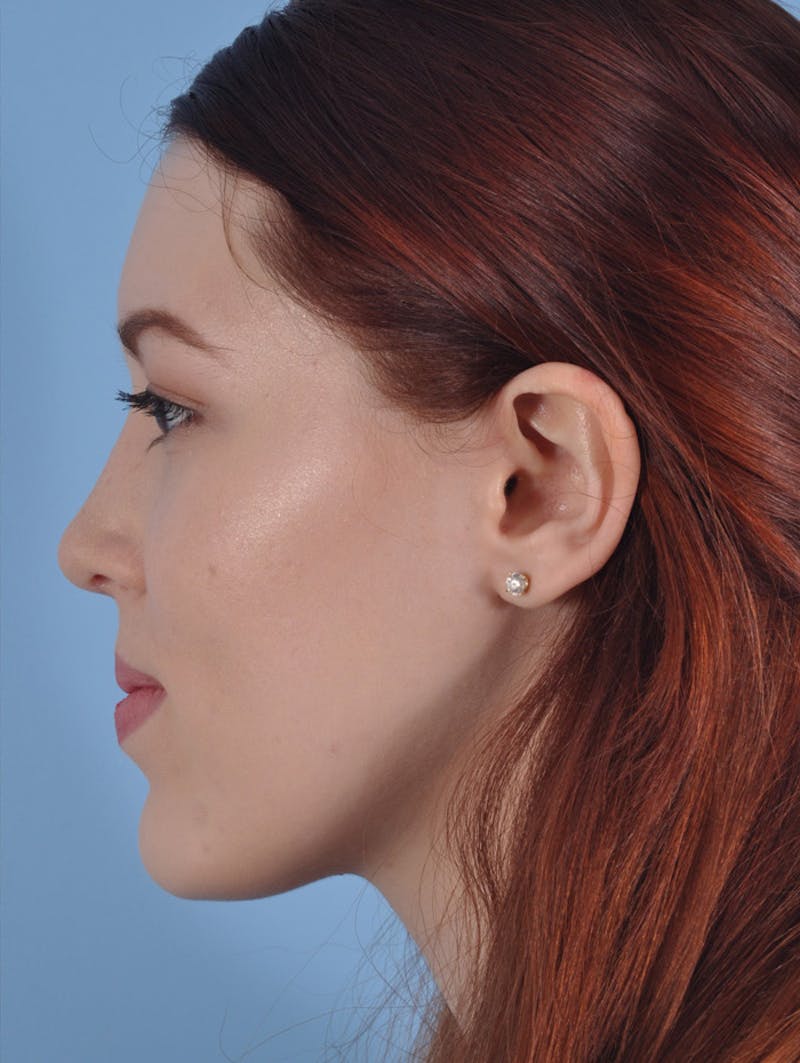 Rhinoplasty Before & After Gallery - Patient 295083 - Image 2